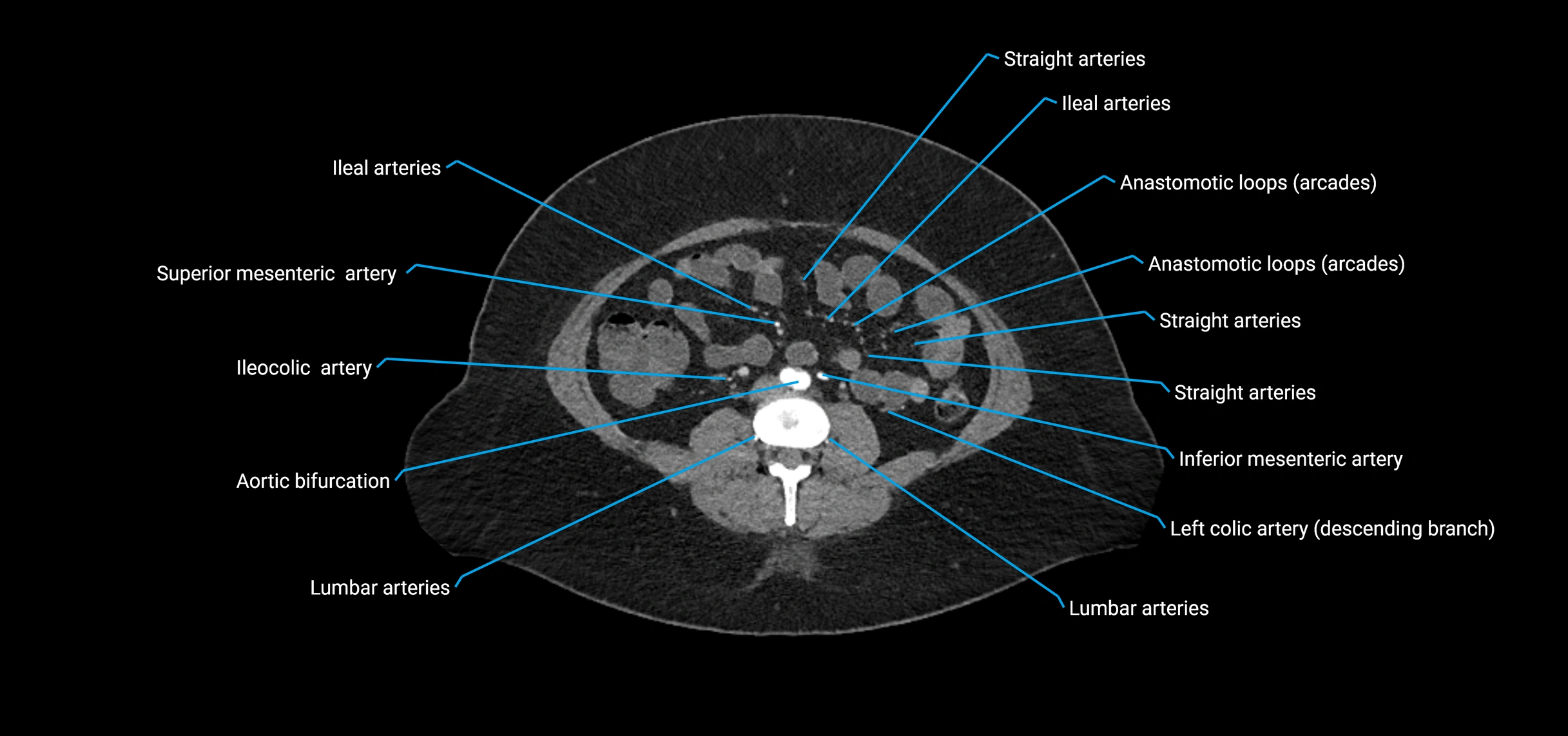 CTA abdomen axial cross sectional anatomy labelled image_123 (2).webp